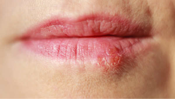 cold sore treatment in ponte vedra beach