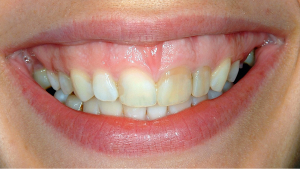 crown lengthening in ponte vedra beach