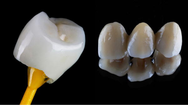 dental crowns & bridges in ponte vedra beach