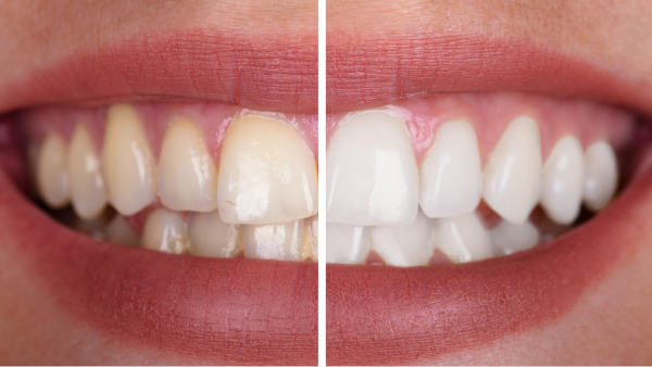 teeth whitening in ponte vedra beach