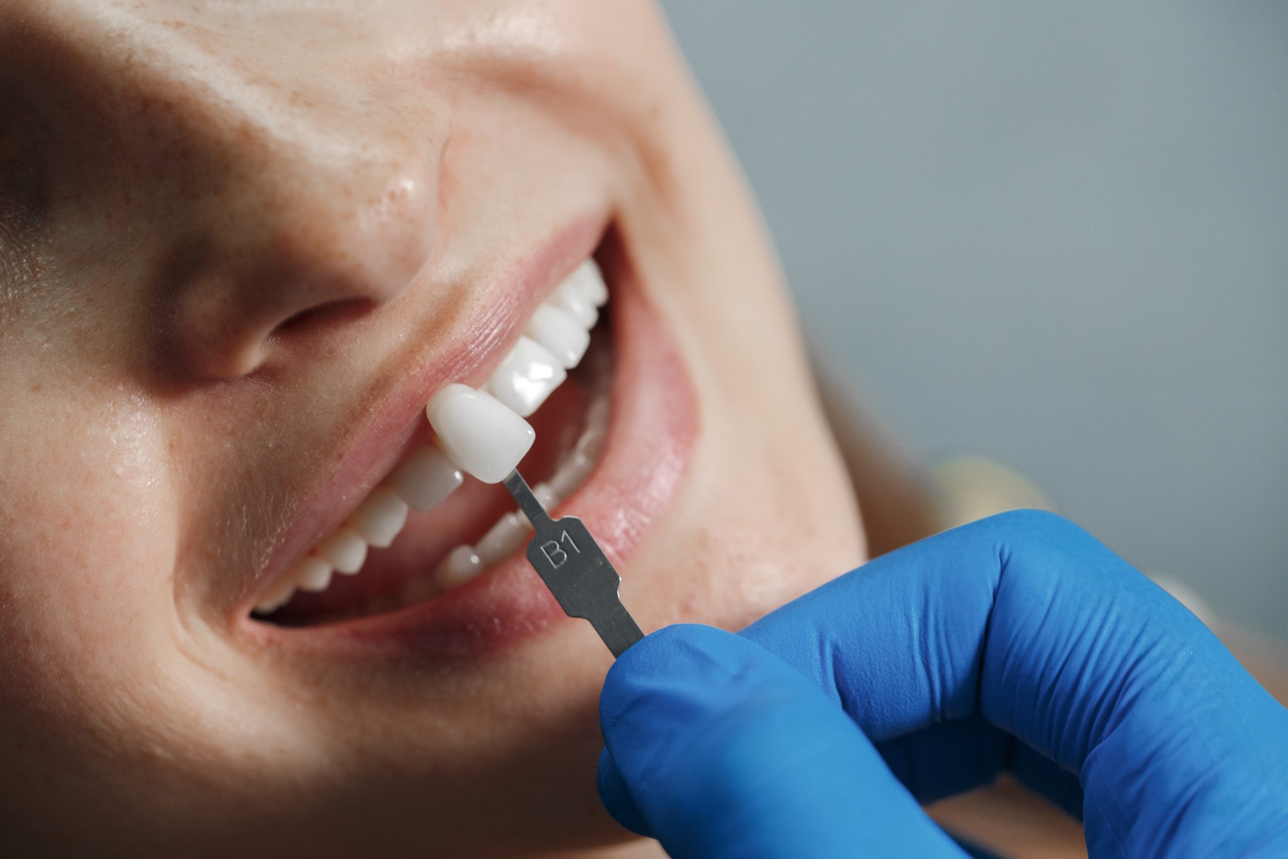 dental veneers for stained or discolored teeth