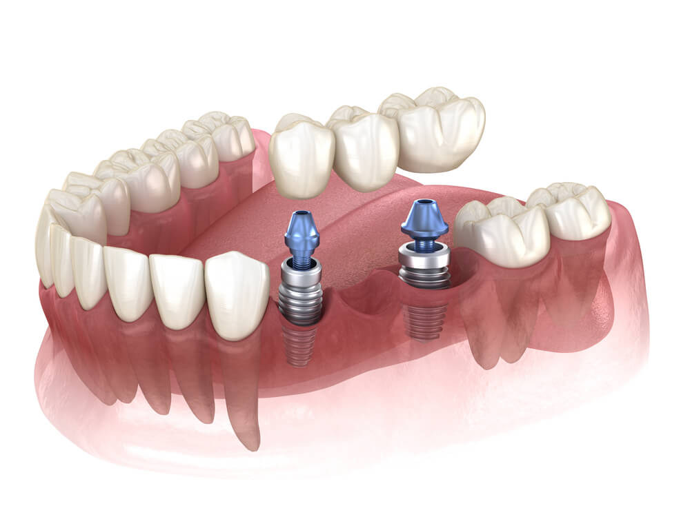 what are your options for replacing missing teeth