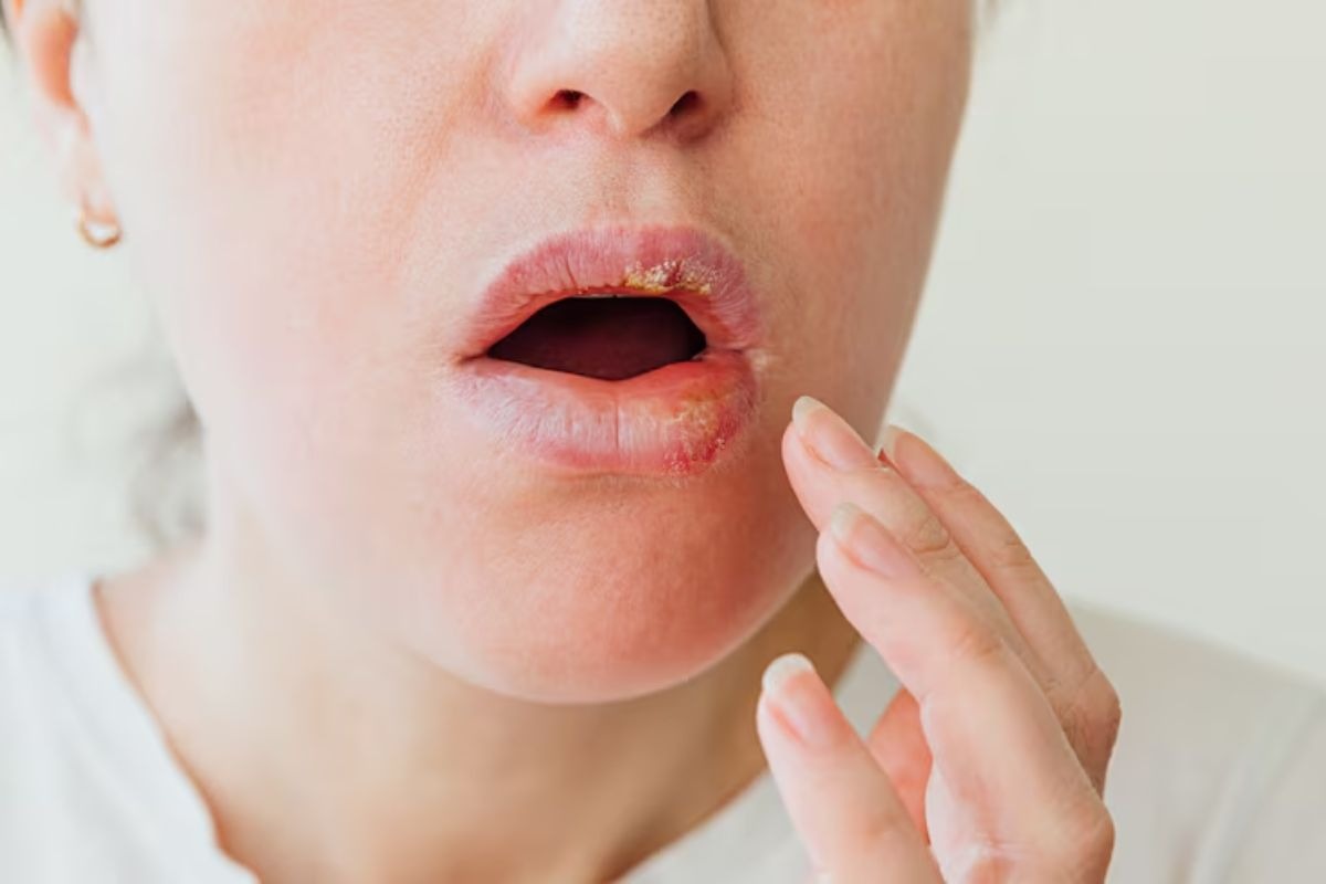 cold sore on patient's lip