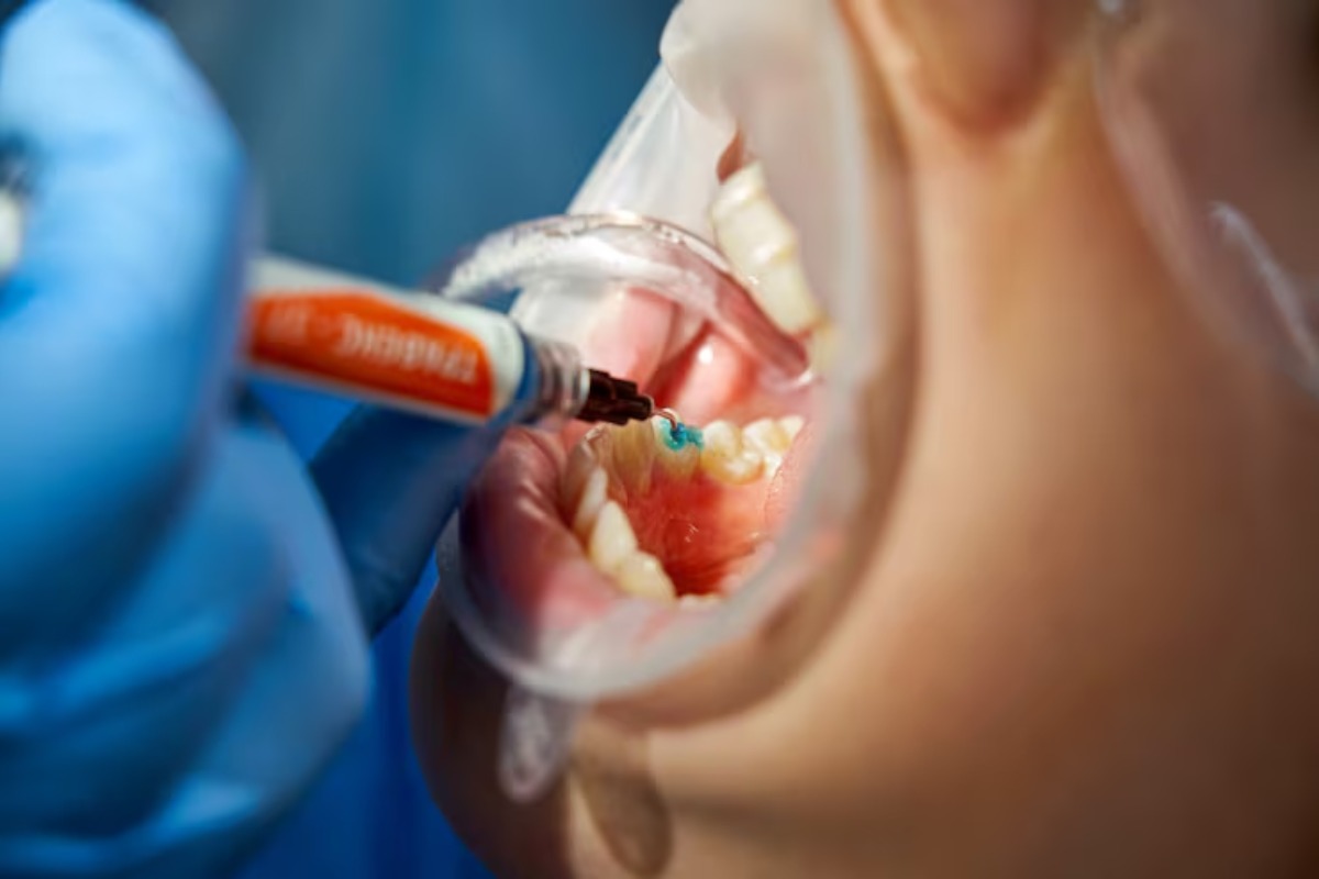 dentist applying blue dental sealant to protect a patient’s tooth from cavities.